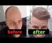 Mr. Hair Transplant