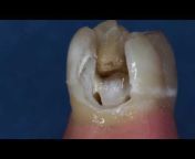 Dentinaltube Channel