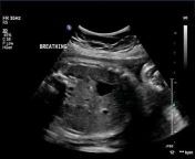 ultrasoundpaedia