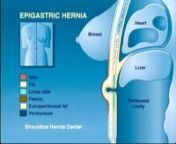 Epigastric Hernia from epigastric hernia