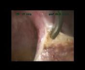 The video demonstrates laparoscopic excision of superficial endometriosis and left salpingectomy in a 30-year-old nulliparous patient. The patient presented with a 4-year history of primary infertility, pelvic pain and dyspareunia. Peri-hepatic adhesions and clubbed left fallopian tube suggested past PID and Fitz-Hugh-Curtis syndrome. nnThese procedures were performed to improve her painful symptoms and to maximise her chances of successful IVF. The right ureter was identified and nerve-sparing