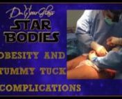 We have previously discussed how the risk of surgical complications increases steadily with a body mass index (BMI) above 35. It is very important to be within a normal weight prior to surgery to help prevent complications like seroma, infection, and slow wound healing, among other things. When a tummy tuck is performed, a lower abdominal incision is done and then dissection is continued toward the midline; the abdominal wall is tightened, the excess skin is removed, and the incision is closed w