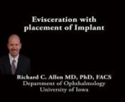 This video demonstrates an evisceration with placement of a solid spherical implant.The patient has a blind painful and has undergone preoperative ultrasound to rule out any intraocular mass.A 360 degree conjunctival peritemy is performed with Westcott scissors.This is followed by a stab incision with a super sharp blade just posterior to the limbus.A 360 degree incision is then made with Westcott scissors just posterior to the limbus.The cornea is removed and an evisceration spoon is