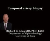 This is Richard Allen at the University of Iowa. This video demonstrates a temporal artery biopsy.The artery has been palpated and marked with a marking pen. A bit of hair has been shaved.The area is then infiltrated with lidocaine with epinephrine around the area.Care is taken not to inject directed into the artery.A 15 blade is then used to make an incision through the skin to expose the underlying subcutaneous fat. Hemostasis is attained with bipolar cautery.A cotton tip applicator