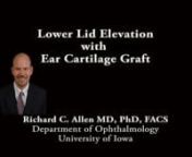 This is Richard Allen at the University of Iowa.This video demonstrates the use of an ear cartilage graft to address lower eyelid retraction.4-0 silk sutures are placed through the lower eyelid at the level of the meibomian glands in order to provide traction during the case.The needle tip cautery is then used to make a subciliary incision extending from the lateral cantus laterally to the punctum medially.Dissection is then carried out between the orbicularis muscle and orbital septum i