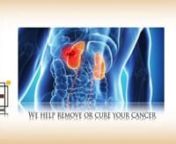 If you are diagnosed with Cancer in the Bladder, KCUC urology experts can help! They are the ideal choice for effective treatment, considering number of factors such as health, age, tumor type and grade, Visit: http://www.kcurology.com