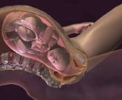 Esta animación médica tridimensional (3D) comienza mostrando un parto vaginal utilizando como escenario un corte sagital de la pelvis de la madre. Las contracciones del útero empujan al bebé a través del canal de parto. Mientras siguen las contracciones uterinas fuertes, vemos que el hombro del infante queda atrapado debajo del hueso pélvico de la madre (sínfisis púbica), provocando estiramiento y lesión de los nervios del plexo braquial (resaltado para visibilidad). Esta acción puede