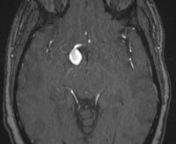 Large complex thrombosed saccular aneurysm at right carotid terminusn Aneurysm appears to be incorporating the origin of right anterior cerebralnartery and origin of right middle cerebral artery