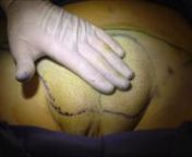 Tumescent liposuction technique full case unedited. Demonstration of patient with lipodystrophy.