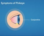 Pink Eye - Symptoms from pink eye symptoms