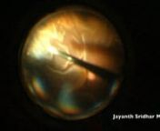 Authors Nicolas Yannuzzi, MD, James Lin, MD, and Jayanth Sridhar, MD, demonstrate their technique for filling the eye with perfluorocarbon liquid in a retinal detachment repair. This accompanies their article in the November, 2018, issue of Retina Specialist Magazine.