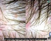 Does COVID and Stress Cause Shock Hair Loss?nn00:00 Announcer: Local 10:00 news starts right now.nn00:02 Kristi Krueger: Plus, some people are so stressed out by the pandemic, they&#39;re losing their hair. We&#39;ll explain why it&#39;s happening and what you can do to stop it, coming up in our health cast. In our health cast today, about one in every five Americans over the age of 30, suffers from some form of hair loss, and that number may be growing during this pandemic. Here&#39;s why it&#39;s happening and wh