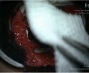 Lumbar spine bleeding management on a Realists RealSpine Herniated Disc L4/L5 model by Prof. Dr. Enrico Tessitore, Deputy Head of Department in Neurosurgery. University Hospital of Geneva, Switzerland.