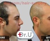 While hair loss usually begins to show later in a man’s life, on occasion a male can experience severe hair loss at a young age. For example, the patient featured here began to suffer from extreme baldness by the age of 23, losing the entirety of his hairline and most of the hair on his crown. Dejected, he had considered hair transplant surgery at other clinics, only to learn that due to the extent of his hair loss and lack of donor areas… he was not eligible for conventional hair restoratio