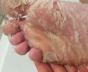 Dead skin peel off feet Baby foot (visit webpage) from baby feet foot peel