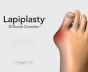 The innovative Lapiplasty® Three-Dimensional Bunion Correction procedure enables a precision realignment of the 3D anatomy, utilizes advanced fixation designed to permanently correct the unstable foundation (the root cause of the bunion), and allows the patient get back on their feet quickly.nnM024 Rev. Cnnversion