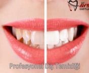 Bu video da diş taşı temizliği(Profesyonel Diş Temizliği) gösterilmiştir. nDİŞ TAŞI VE PLAĞI TEMİZLİĞİ NEDİR? NASIL YAPILIR? FAYDALARInÜlkemizde yapılan bir araştırmada, araştırmaya katılanların yaklaşık %65&#39;inde diş taşı olduğu tespit edilmiştir. Sağlıklı diş ve dişetleri için 6 ayda bir ya da hiç değilse yılda bir diş taşı temizliği yaptırılmalıdır. Profesyonel diş temizliği, dişlerde birikmiş bakteri plağının (yumuşak, yapışkan, bak