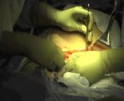 This is a training video, used to teach OB/GYN first year residents and 3rd year medical students the basics of cesarean delivery.