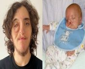A mum who was told she was “cruel” for having her son after he was born with a rare severe cleft lip says it has never held him back.&#60;br/&#62;&#60;br/&#62;Zac Coates, now 18, was born with Tessier cleft lip and palate – a condition which is caused by facial tissues not joining up properly during development.&#60;br/&#62;&#60;br/&#62;It left Zac with severe facial disfigurement on his ride side and he had no eye lid which left him blind in his right eye.&#60;br/&#62;&#60;br/&#62;Mum, Joanne Lythgoe-Frank, 58, was “shocked” when she first saw her son but raised him to accept his differences.